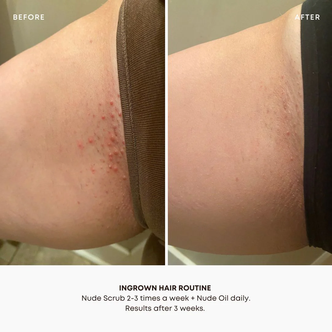 Ingrown Hair + Pre-Post Wax Oil - Image 5