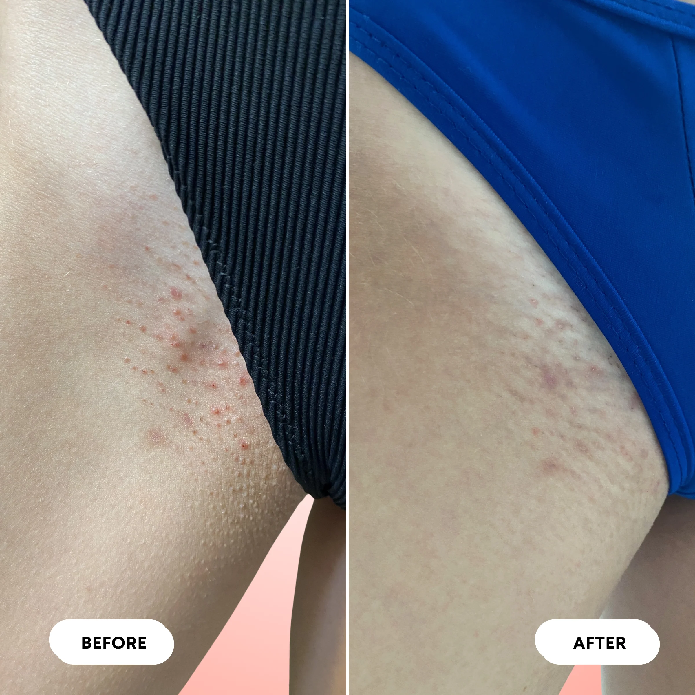 Ingrown Hair Oil & Scrub Bundle - Image 7