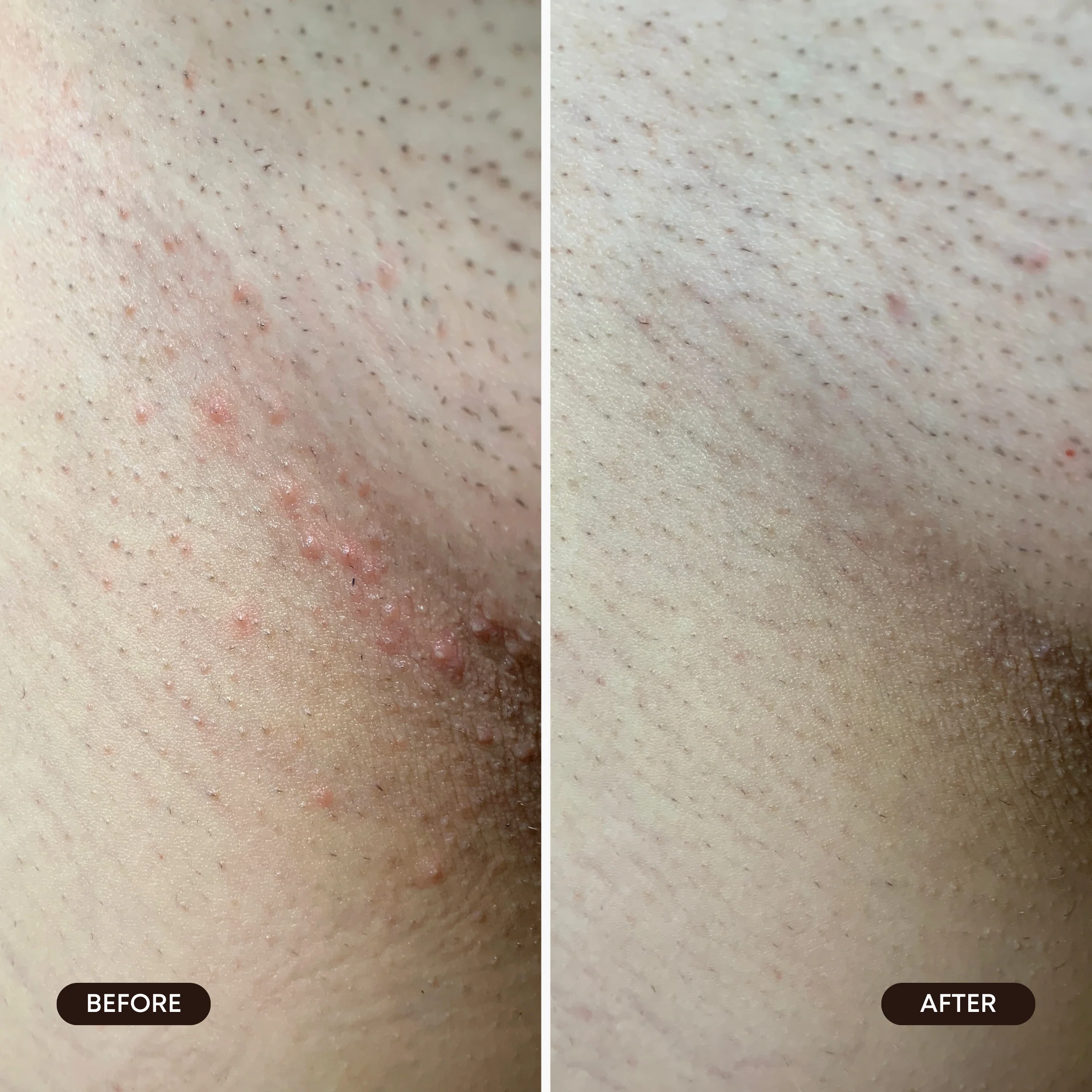 Mini Ingrown Hair Oil - Image 5